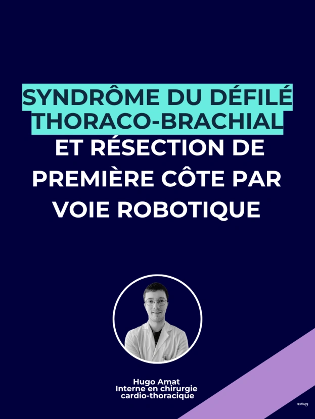 Syndrome du défilé thoraco-brachial et résection de première côte par voie robotique