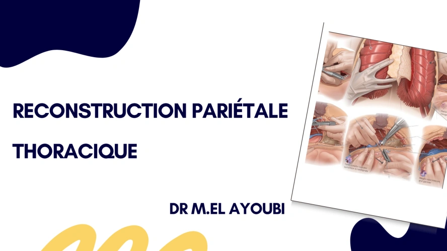 Chirurgie de reconstruction de la paroi thoracique : de la planification multidisciplinaire à la simulation pré-opératoire