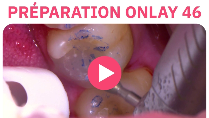 Cas clinique : Préparation Onlay 46