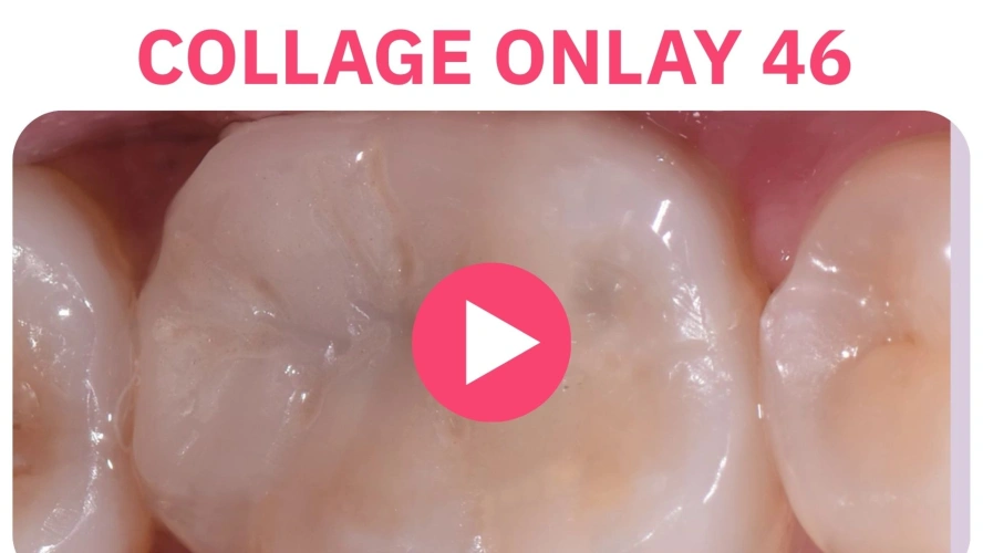 Cas clinique : Collage Onlay 46