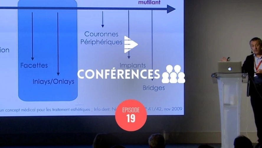 Bridges collés Cantilever