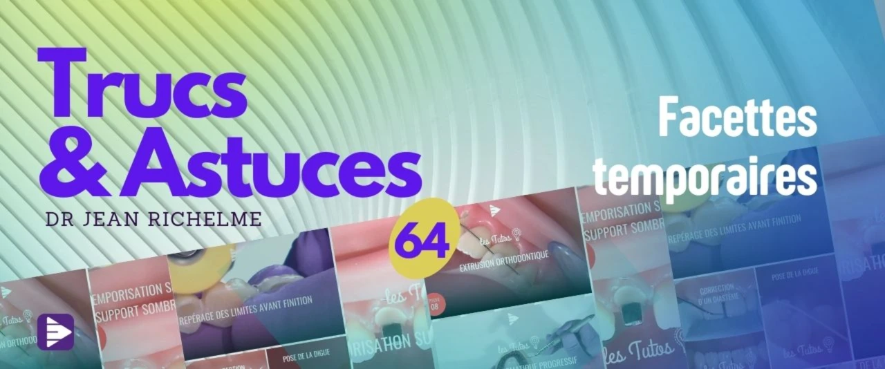 Trucs et astuces : Facettes temporaires