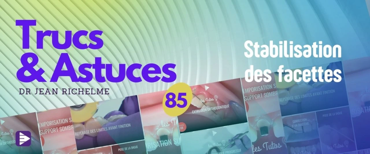 Trucs et astuces : Stabilisation des facettes