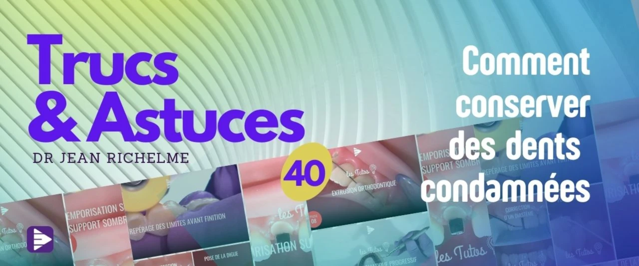 Trucs et astuces : Comment conserver des dents condamnées