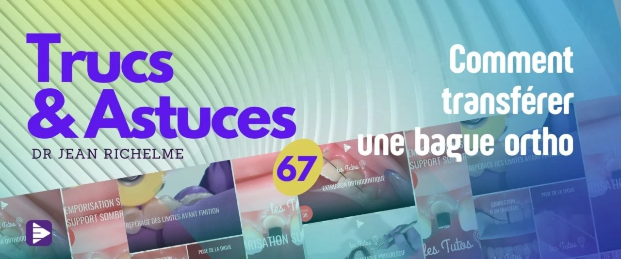 Trucs et astuces : Comment transférer une bague otho ?