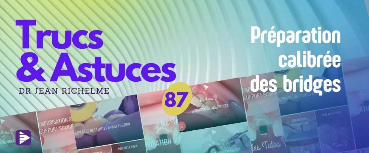 Trucs et astuces : Préparation calibrée des bridges