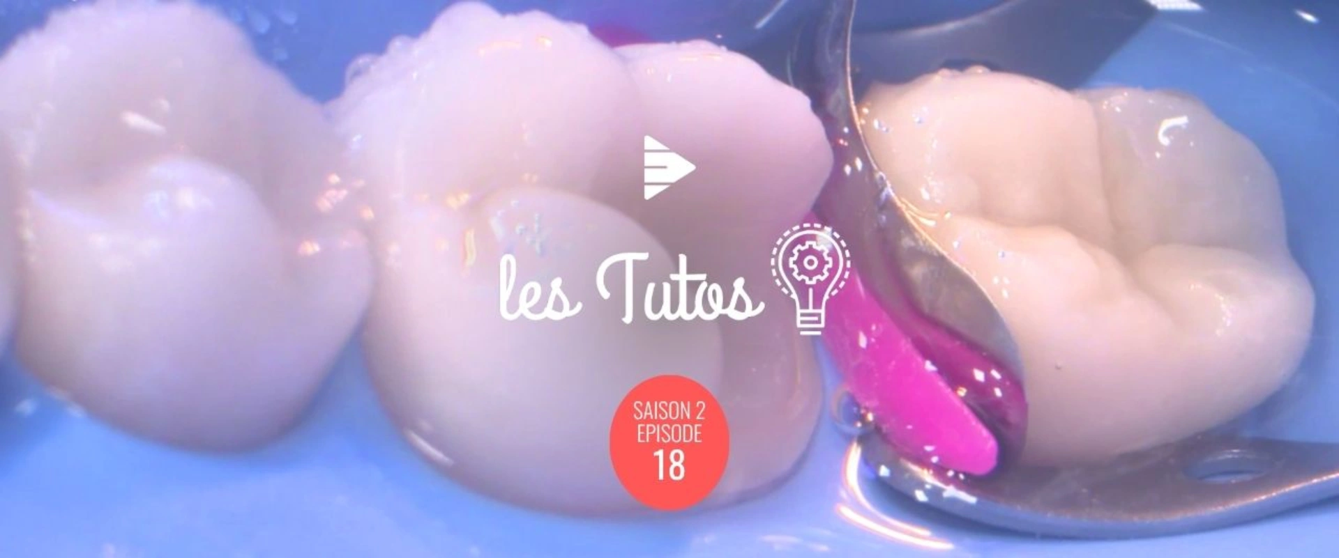 Tuto Gratuit: Préparation d'un Onlay sur la 46