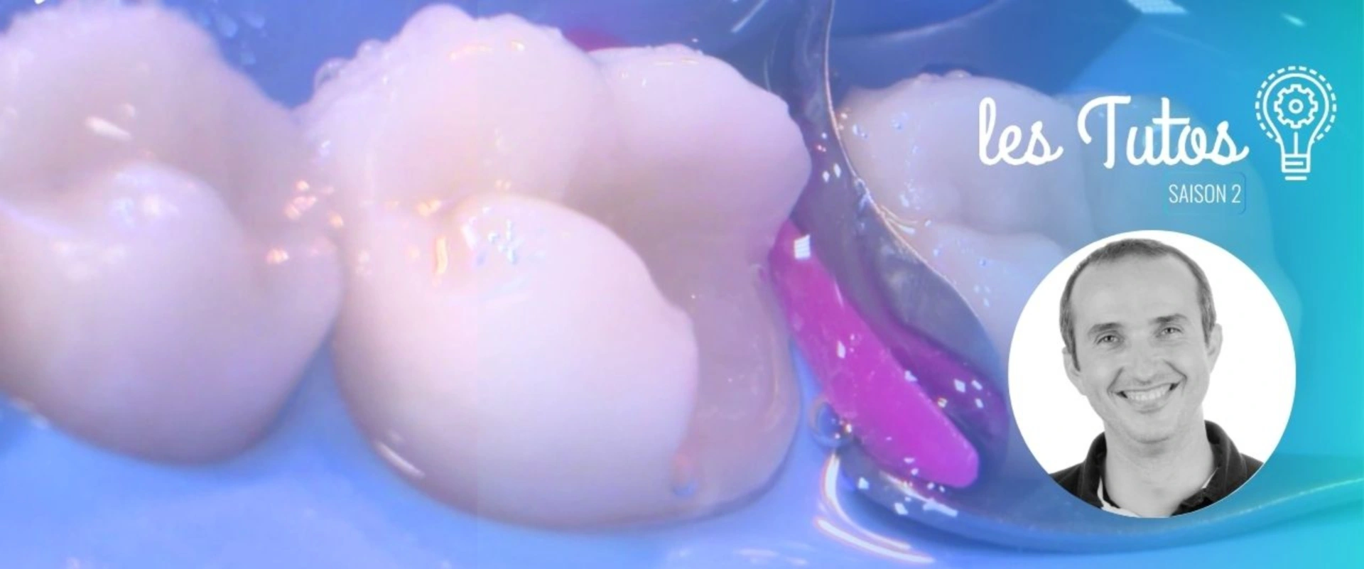 Préparation d'un Onlay sur la 46