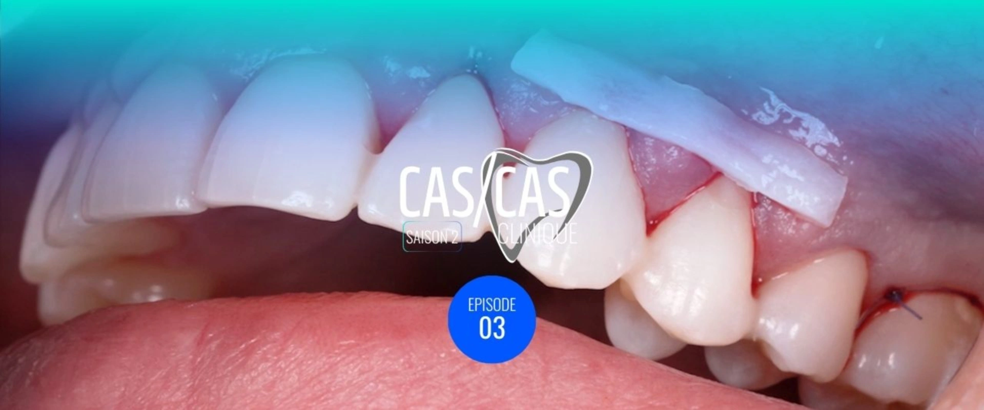 Chirurgie de recouvrement radiculaire par tunnelisation : Mise en place et désépithélialisation