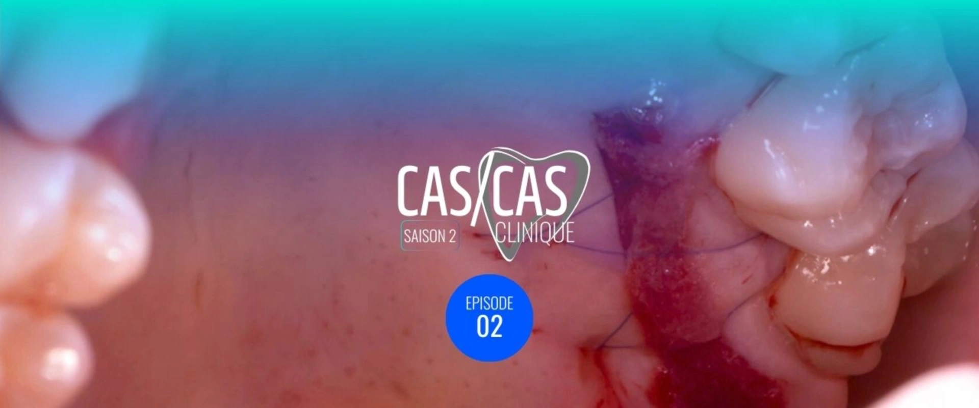 Chirurgie de recouvrement radiculaire par tunnelisation : Prélèvement du greffon