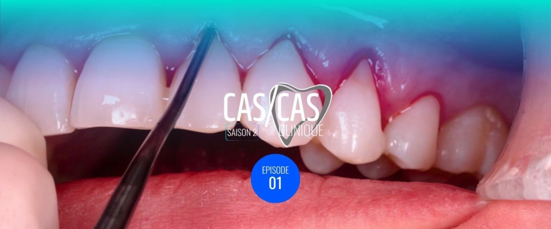 Chirurgie de recouvrement radiculaire par tunnelisation : Préparation