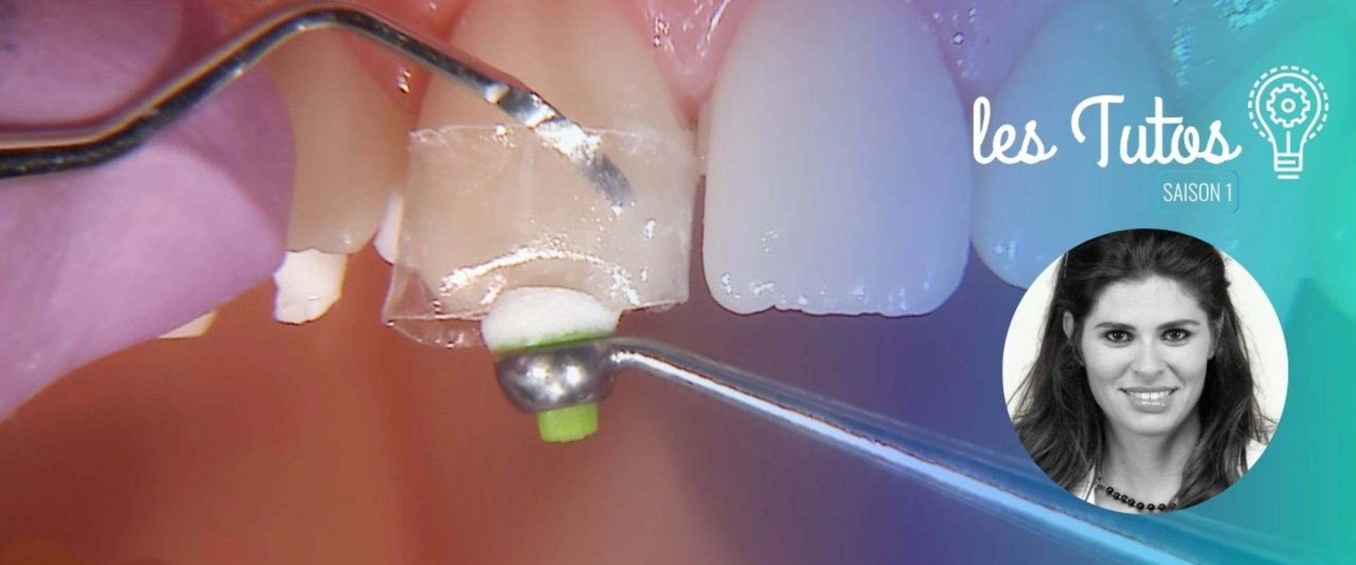 Video gratuite : Collage d'un fragment sans digue