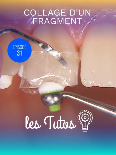 Video gratuite : Collage d'un fragment sans digue