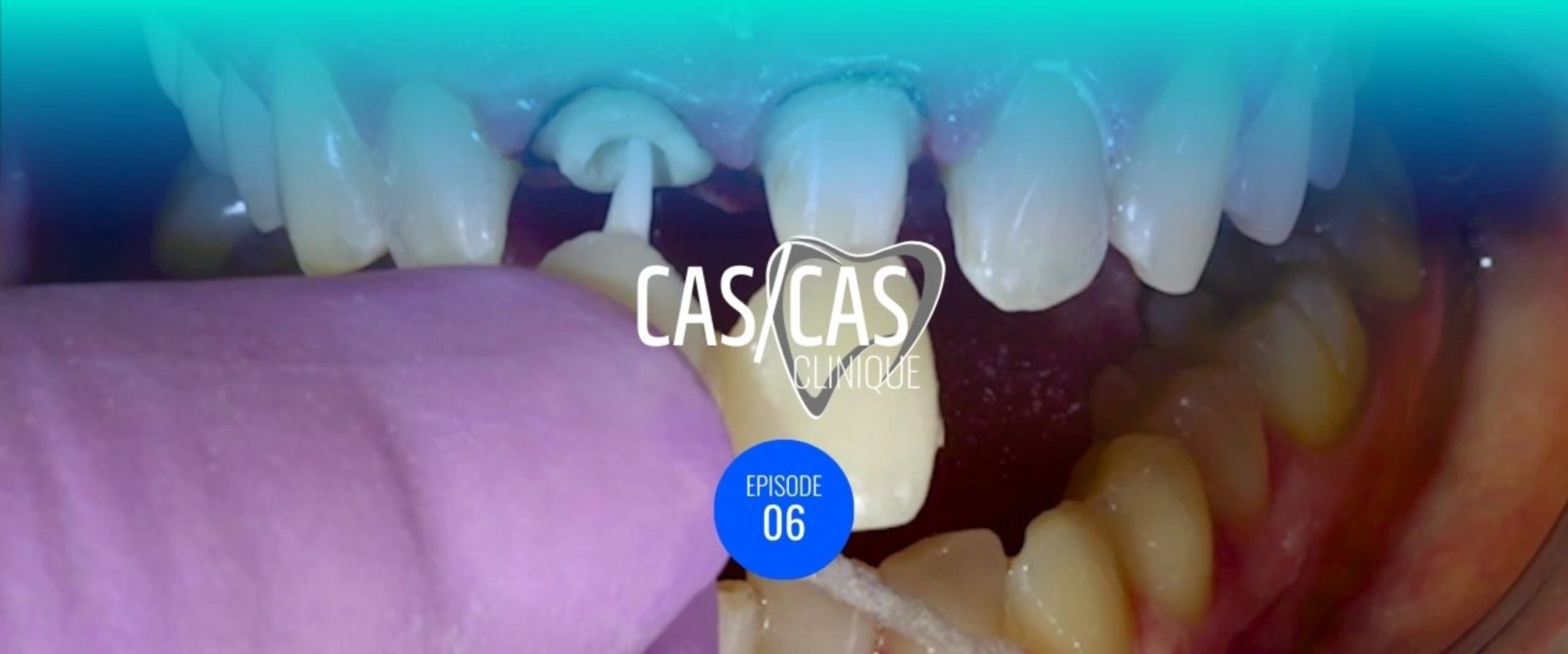 Cas clinique : réhabilitation de 2 incisives centrales par des couronnes céramo-céramiques part.1