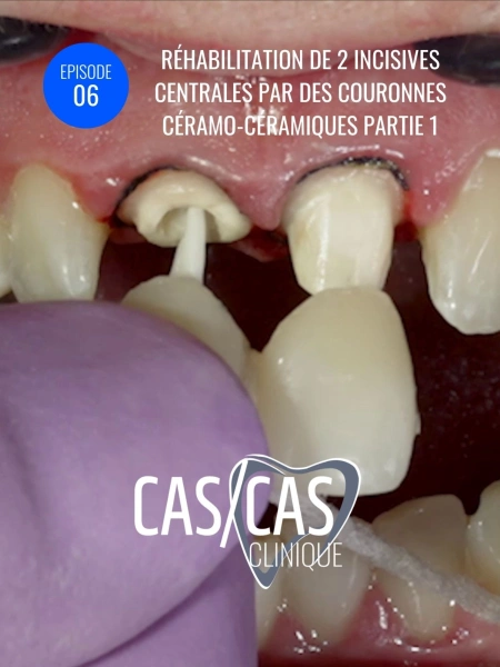 Cas clinique : réhabilitation de 2 incisives centrales par des couronnes céramo-céramiques part.1