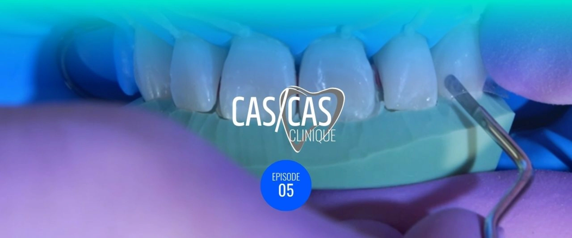 Cas clinique : correction de taches blanches et diastèmes combinés Partie 2