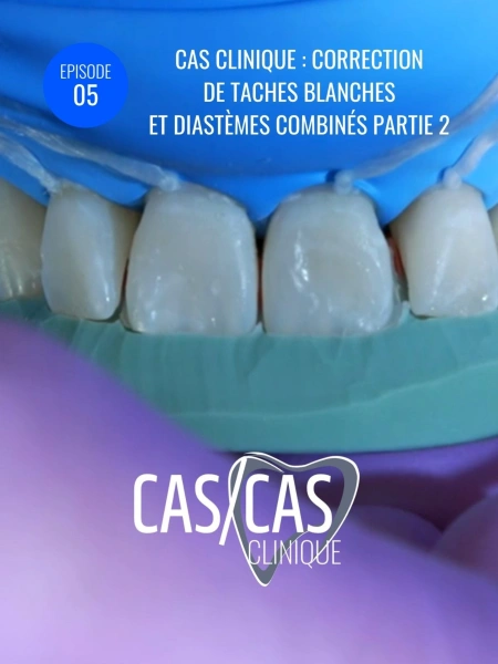 Cas clinique : correction de taches blanches et diastèmes combinés Partie 2