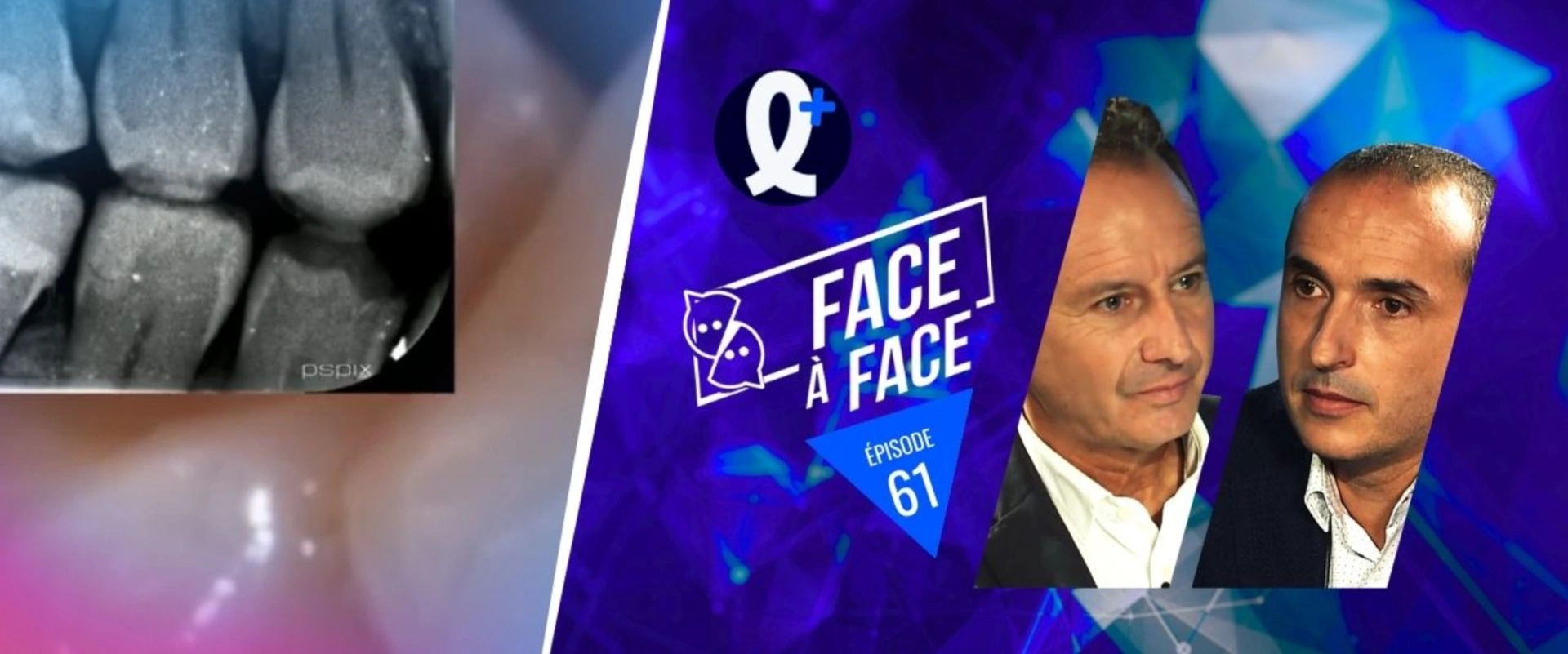 Inlays-Onlays : Les fêlures dentaires