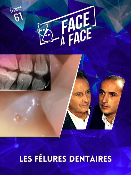 Inlays-Onlays : Les fêlures dentaires