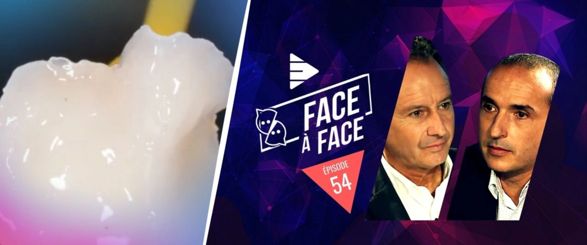 Inlays-Onlays : préparation de l'intrados des vitro-céramiques