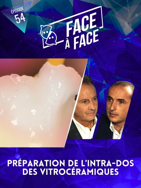 Inlays-Onlays : préparation de l'intrados des vitro-céramiques