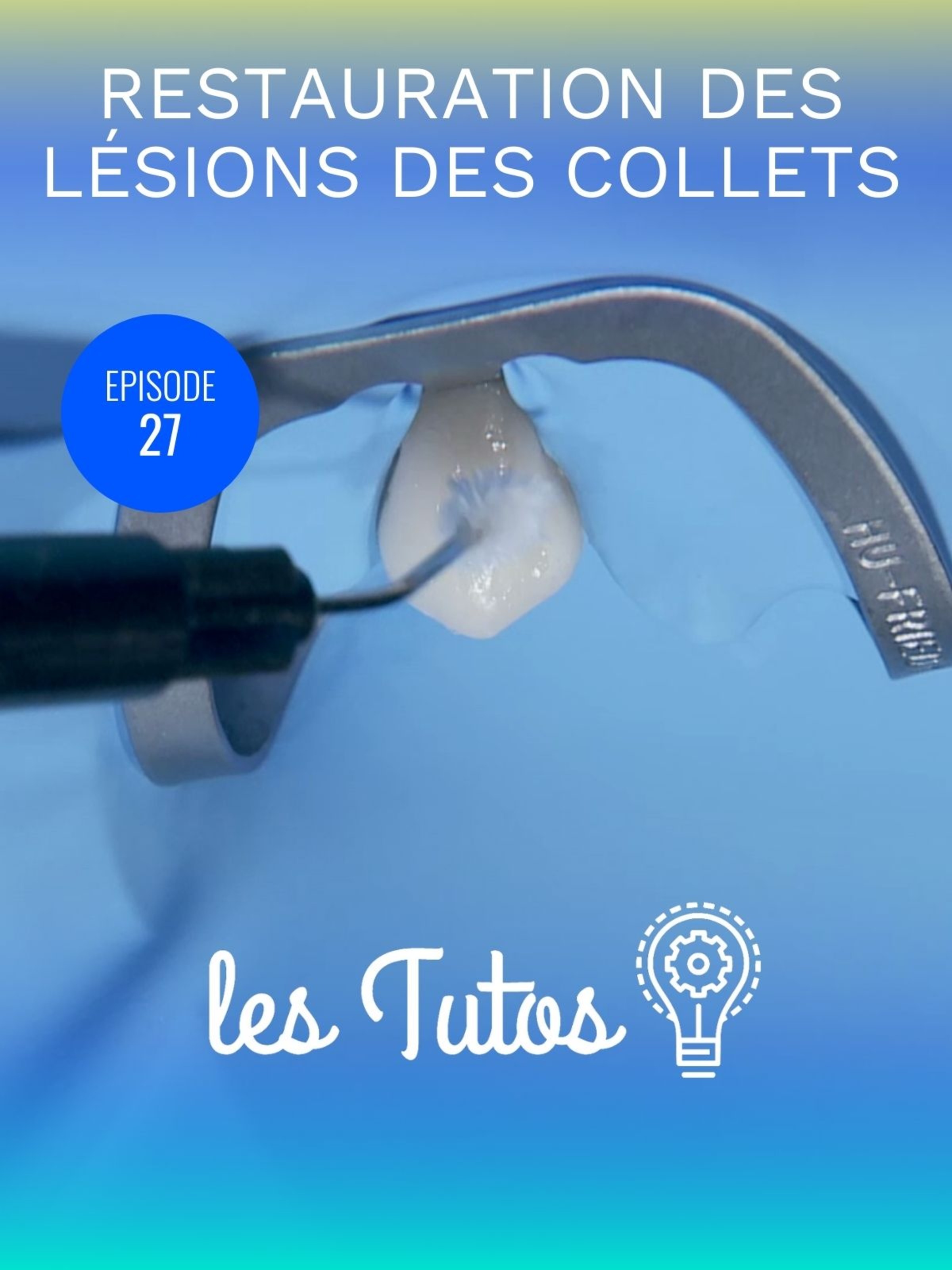Restauration des lésions des collets (Classe V)