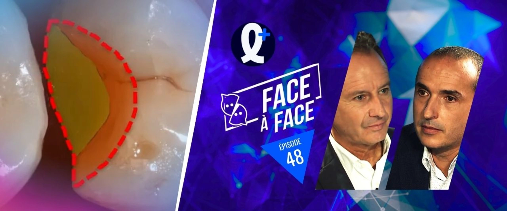 Inlays-Onlays : Préparations