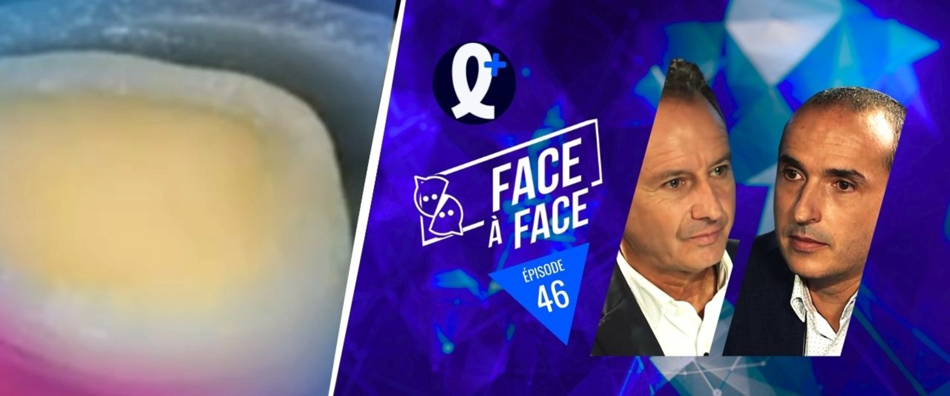 Inlays-Onlays : scellement dentinaire immédiat