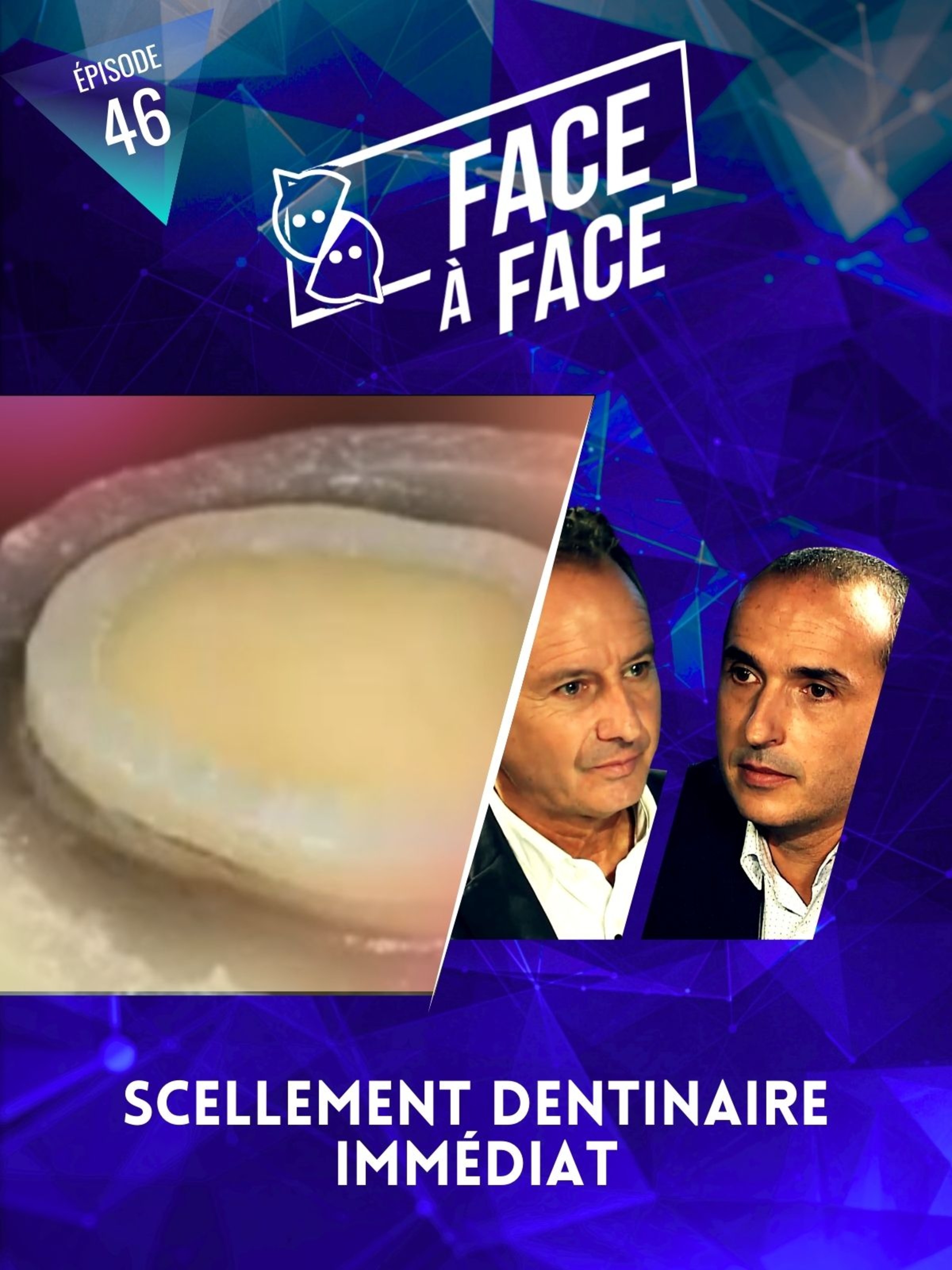 Inlays-Onlays : scellement dentinaire immédiat