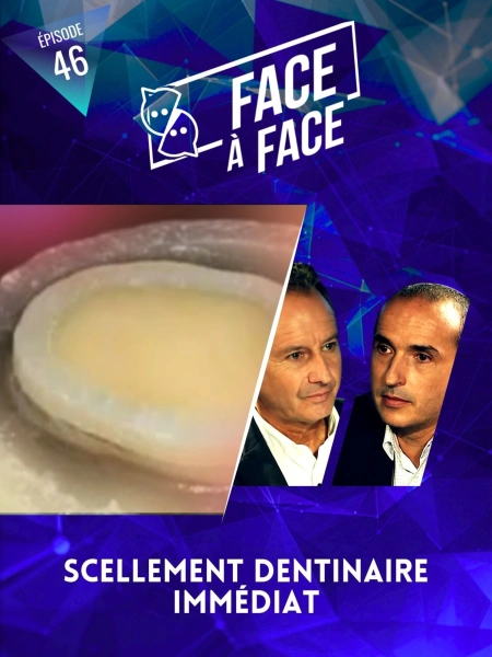 Inlays-Onlays : scellement dentinaire immédiat