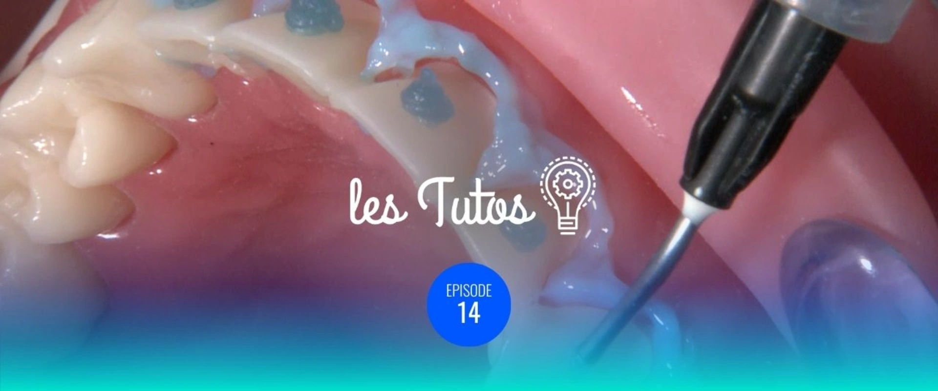 Facettes transitoires