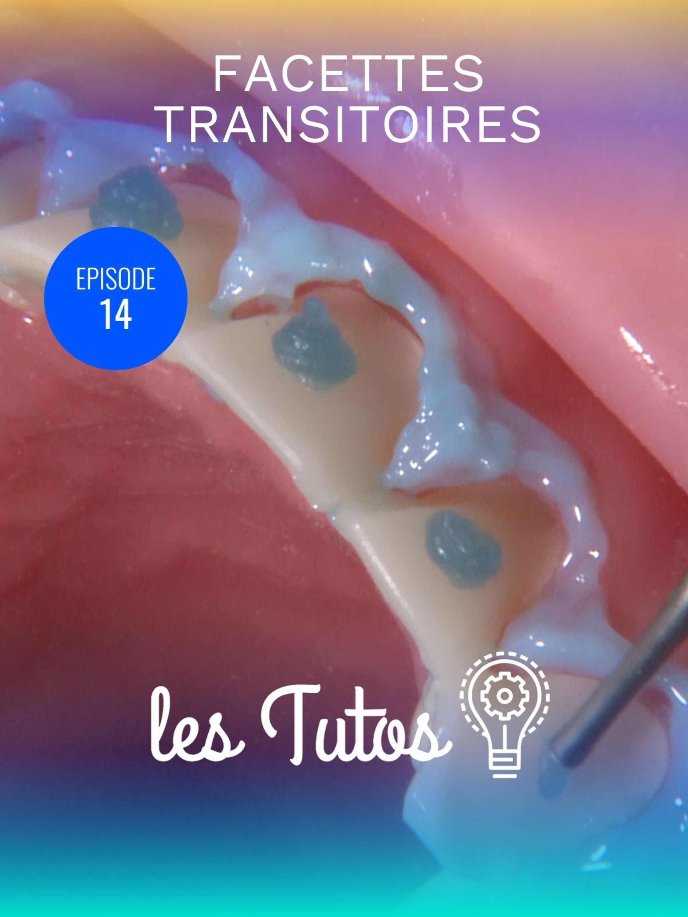 Facettes transitoires