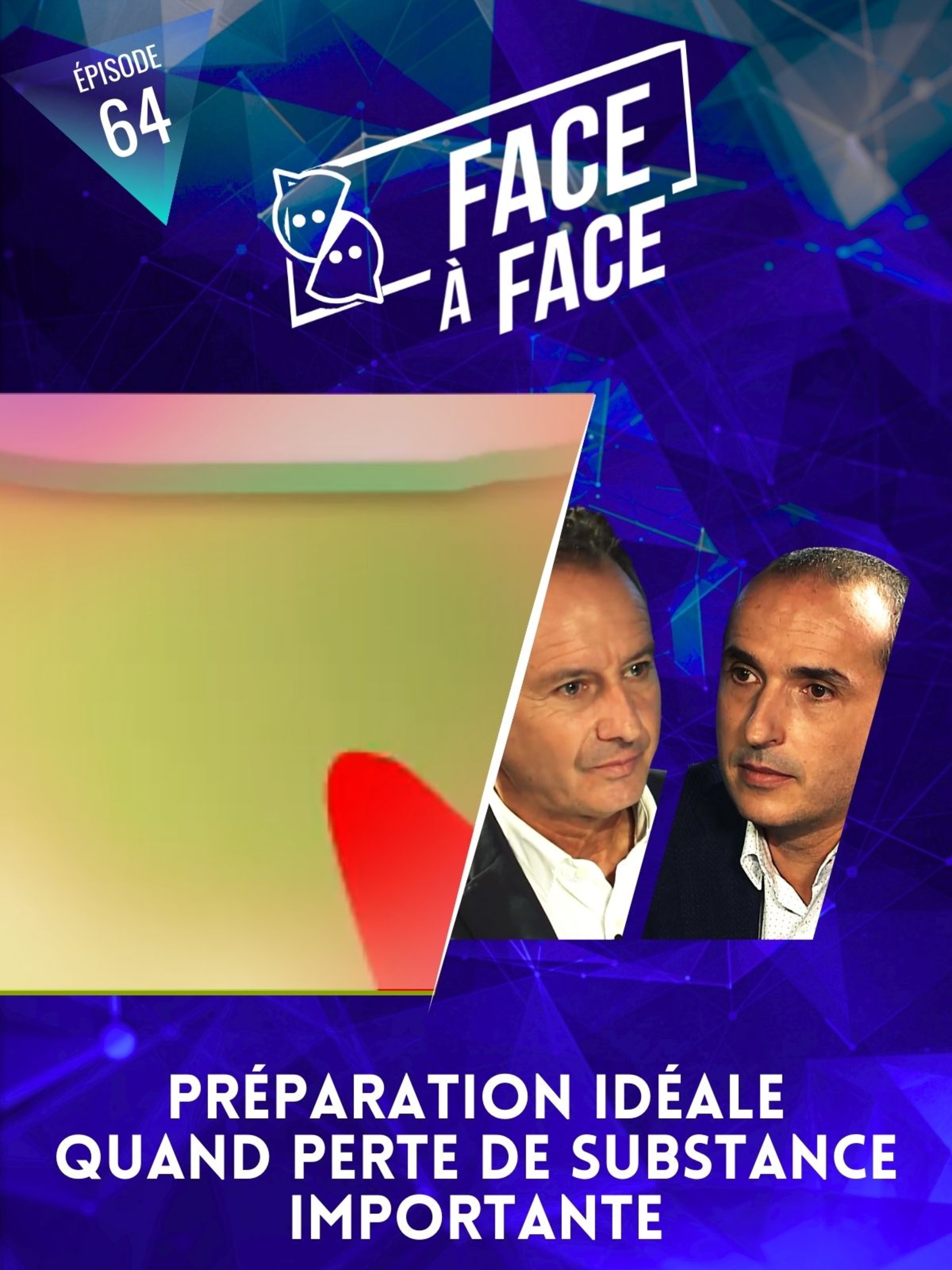 Inlays-Onlays : préparation idéale quand perte de substance