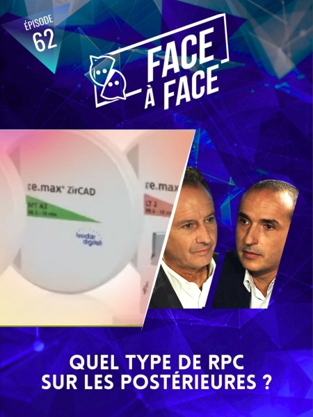 Inlays-Onlays : Quel type de RPC sur les postérieures ?