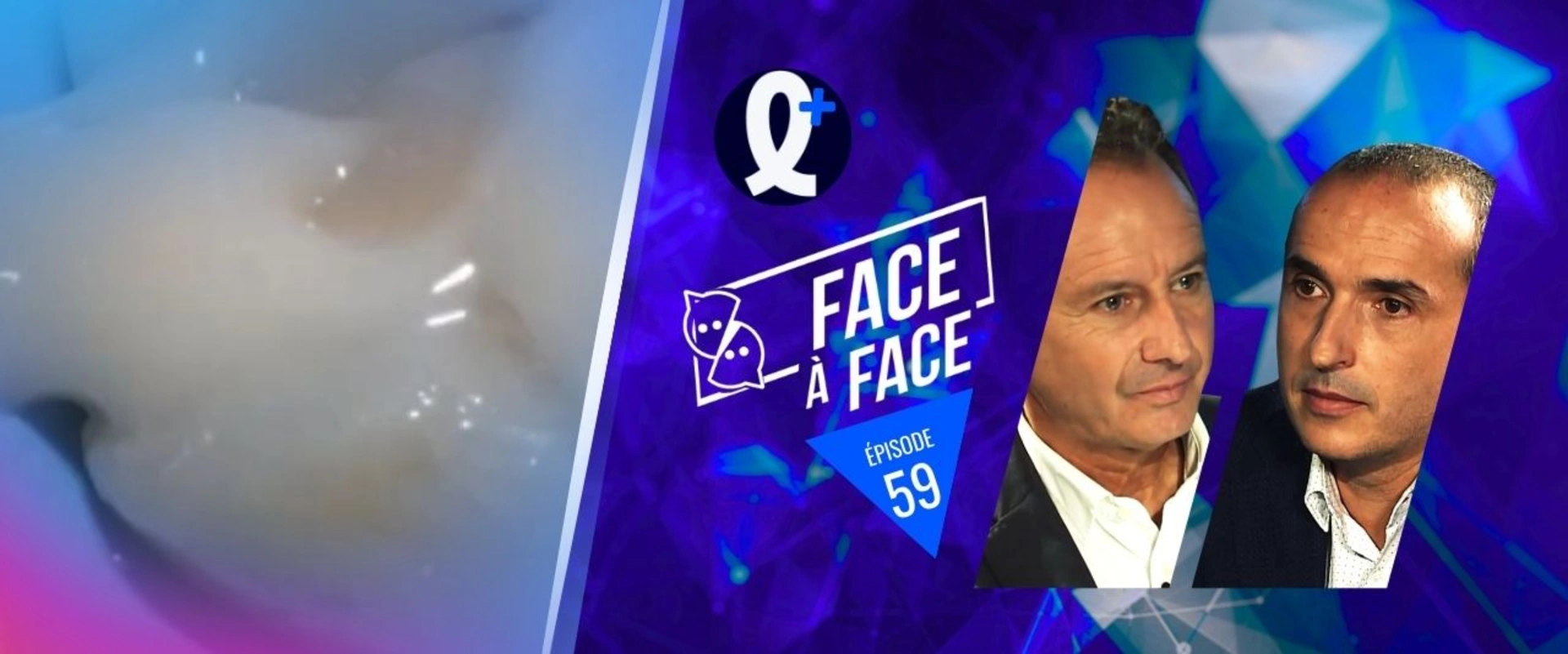 Inlays-Onlays : Quel composite de collage?