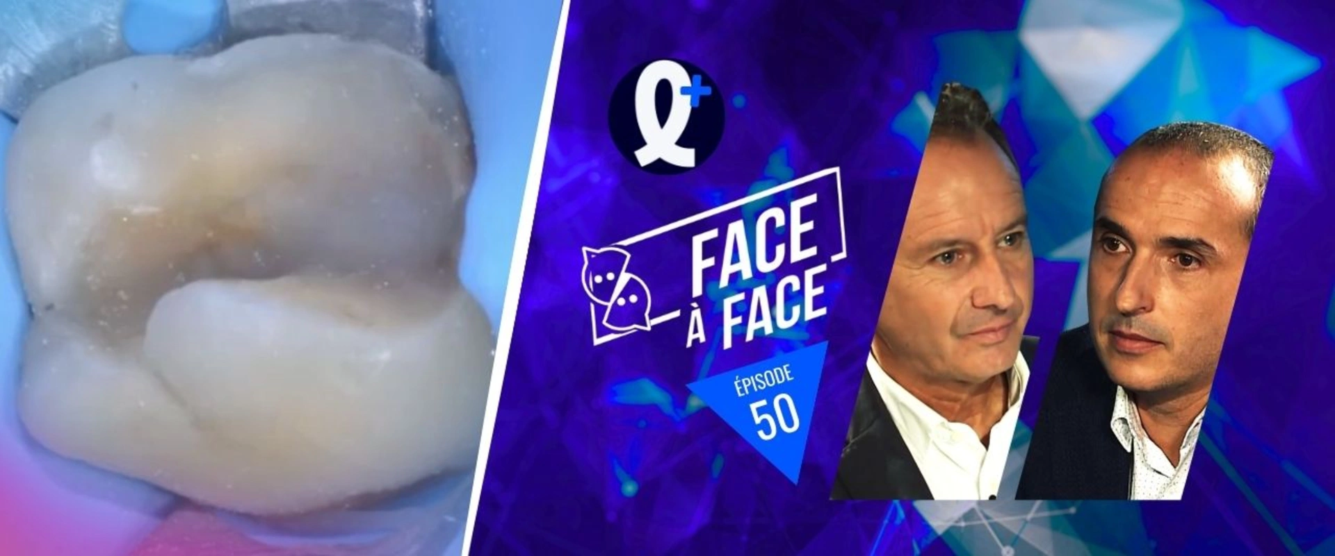 Inlays-Onlays : doit-on sabler la dent ?