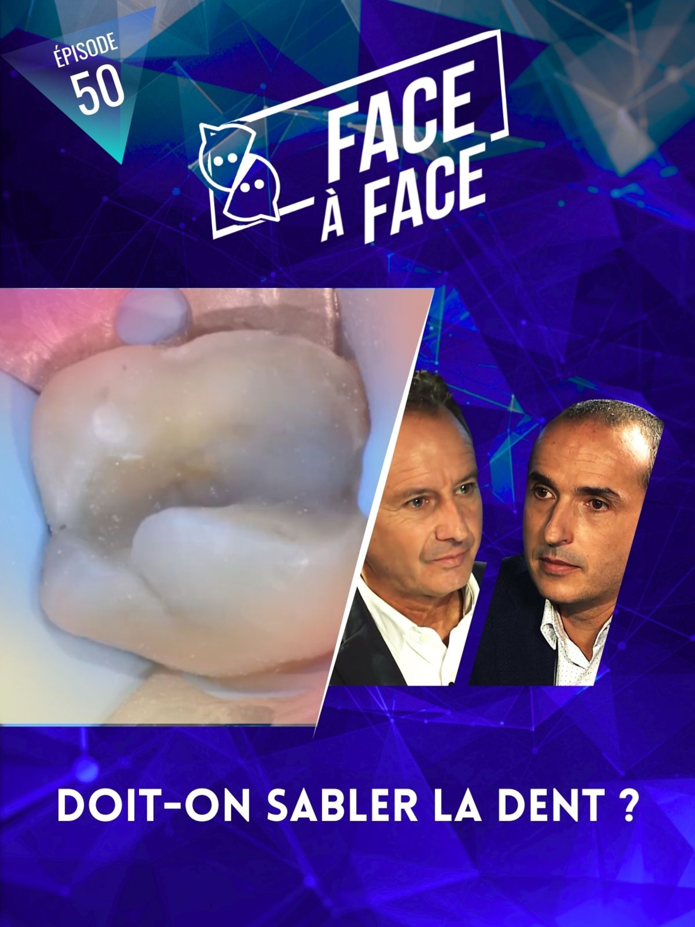 Inlays-Onlays : doit-on sabler la dent ?
