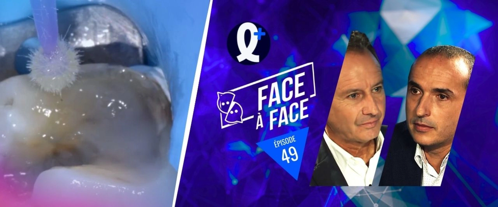 Inlays-Onlays : préparation des tissus dentaires