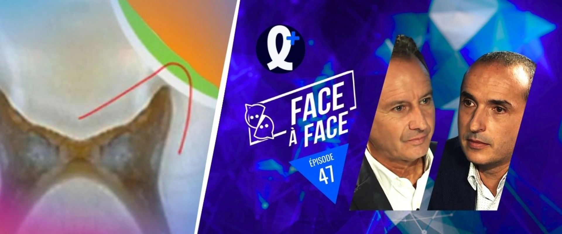 Inlays-Onlays : gestion clinique des caries profondes