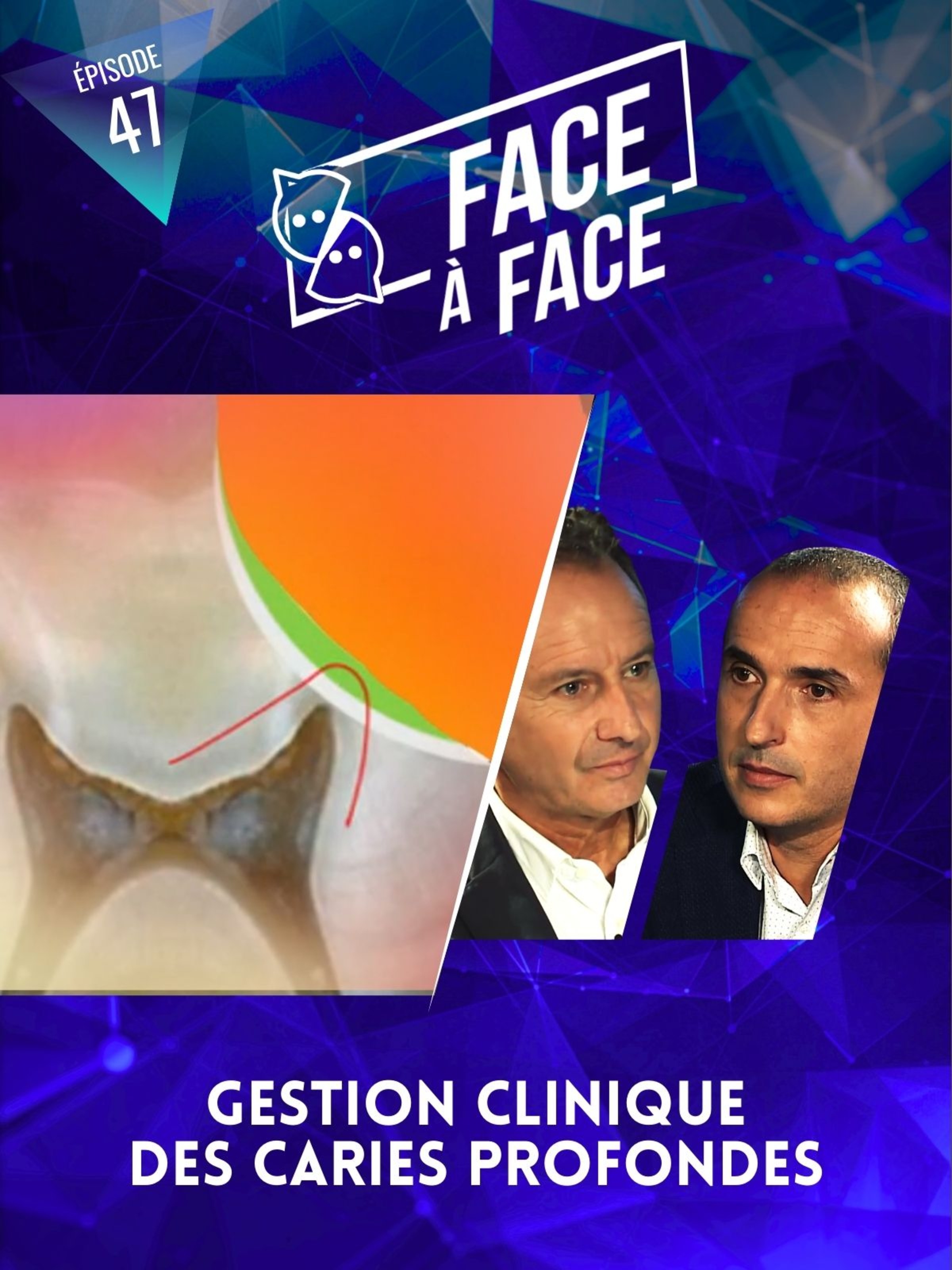 Inlays-Onlays : gestion clinique des caries profondes