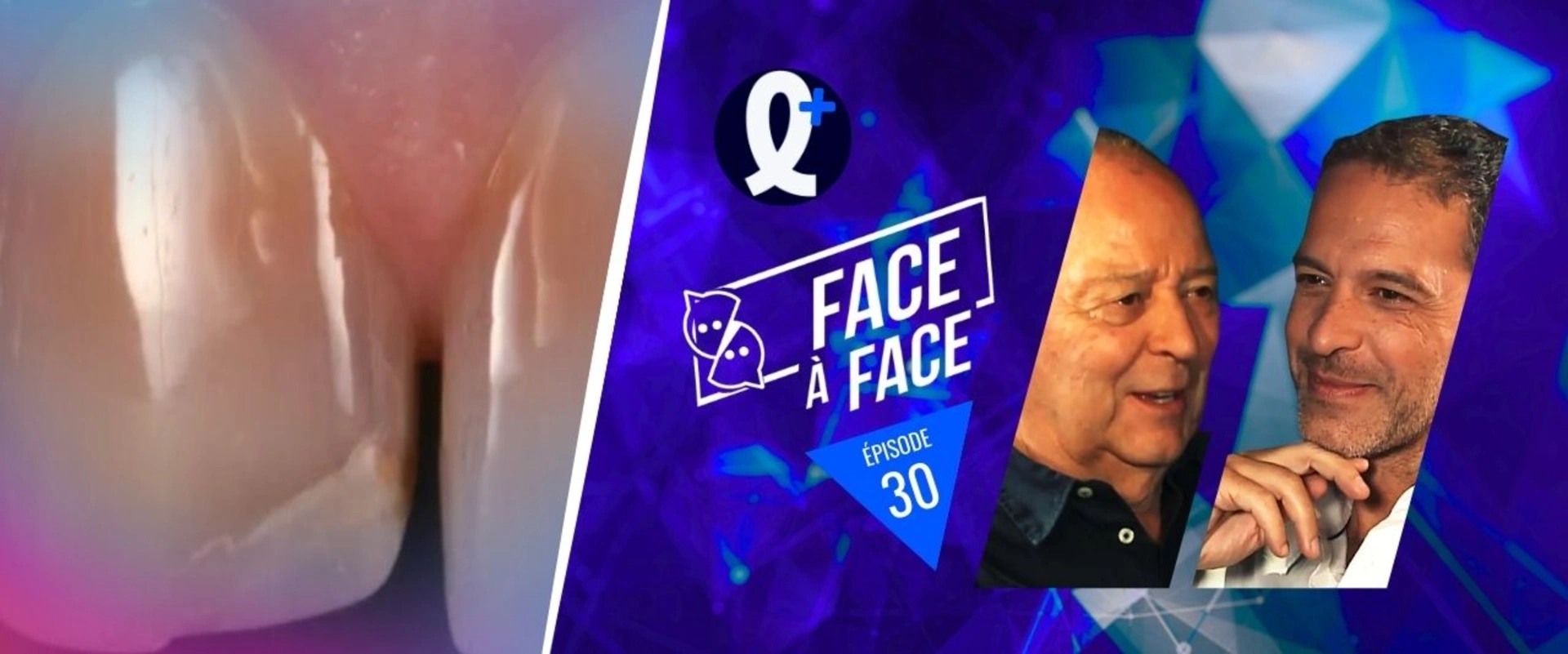 Facettes : Généralités