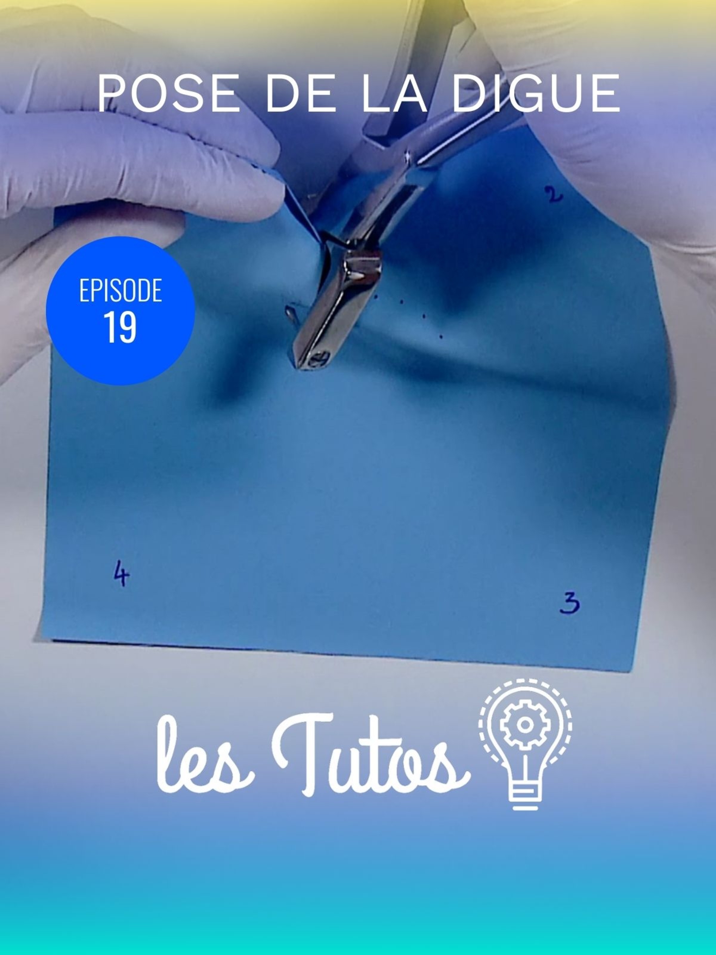 Pose de la digue isolation bloc antérieur (13 à 23)