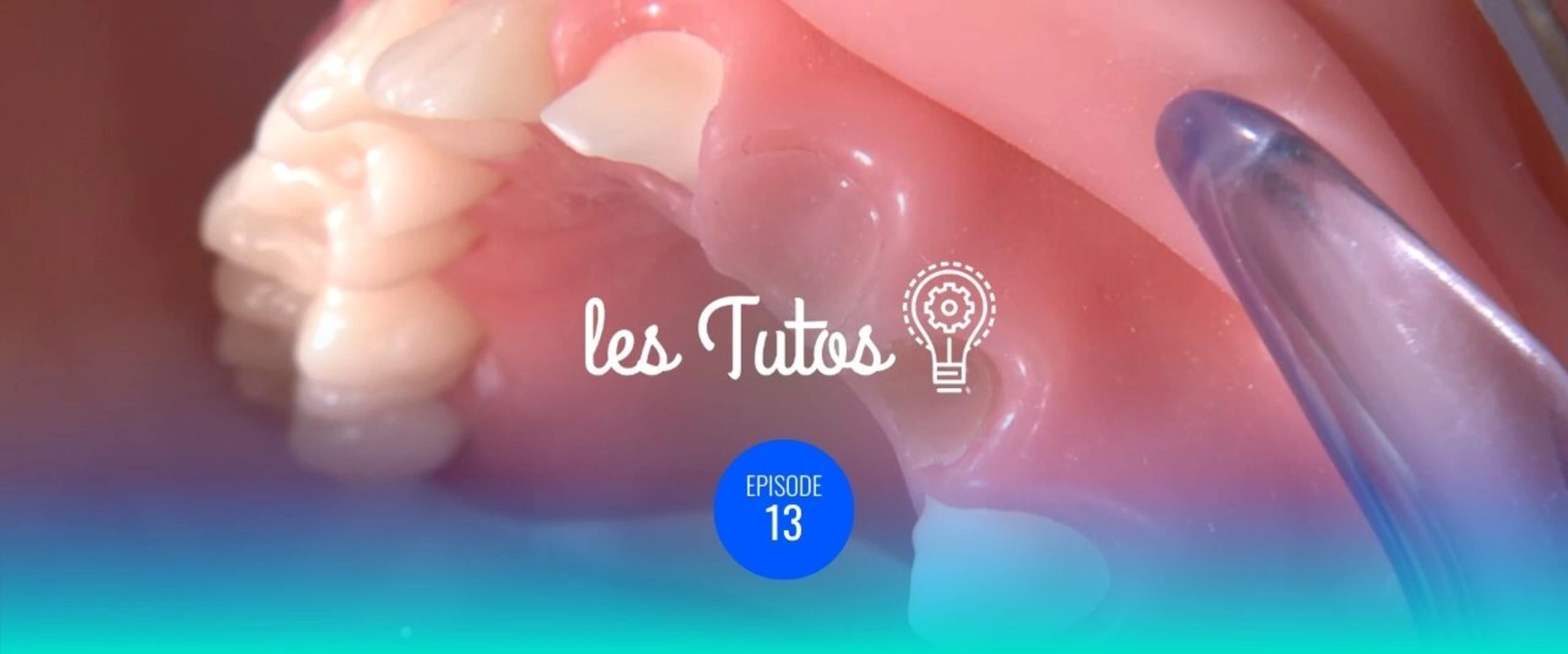 Ajustage du bridge provisoire