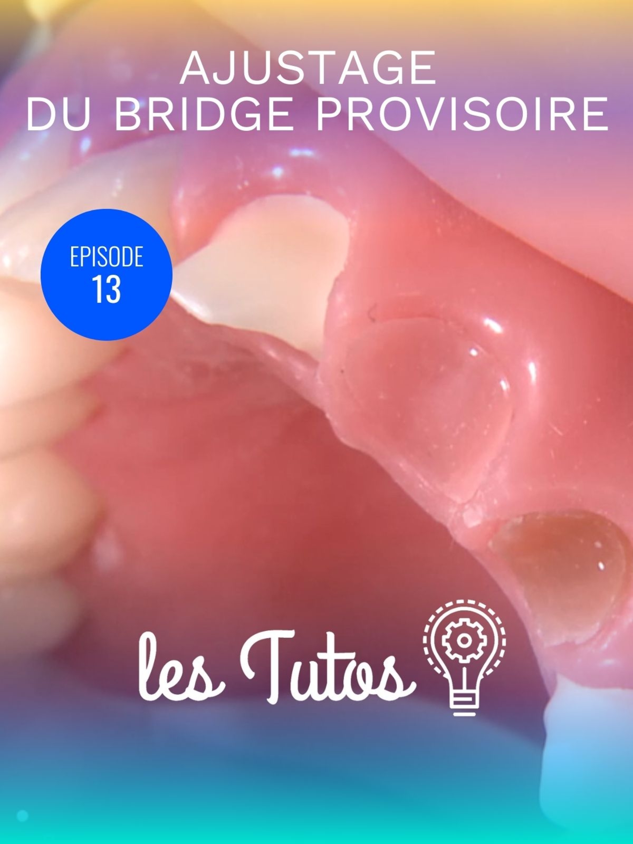 Ajustage du bridge provisoire