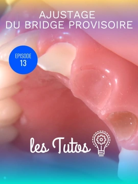 Ajustage du bridge provisoire