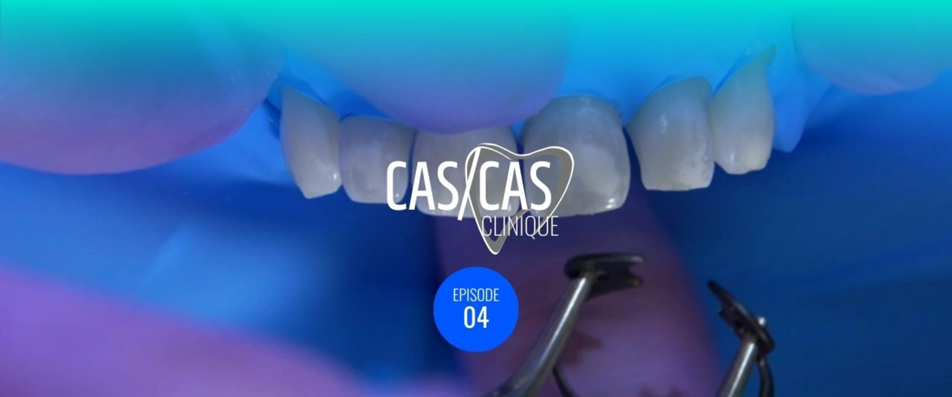 Cas clinique : correction de taches blanches et diastèmes combinés Partie 1