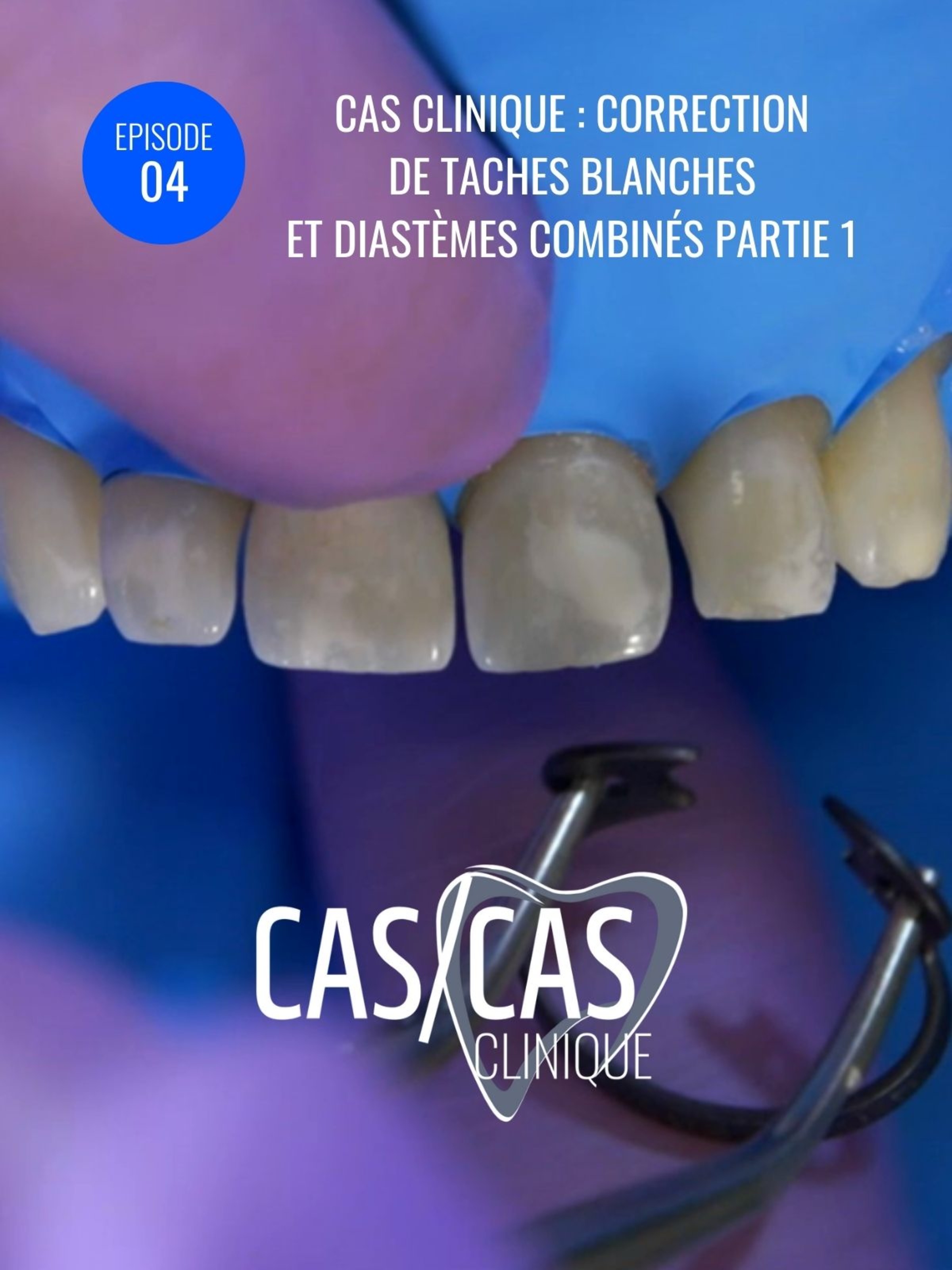 Cas clinique : correction de taches blanches et diastèmes combinés Partie 1