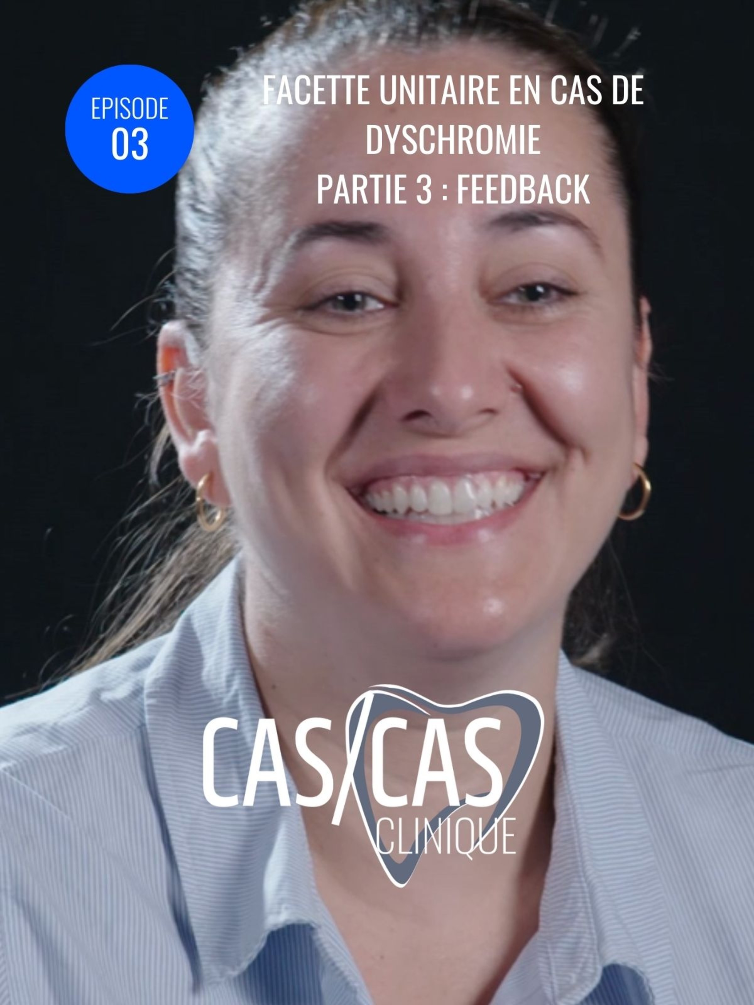 Facette unitaire en cas de dyschromie Partie 3 : Feedback