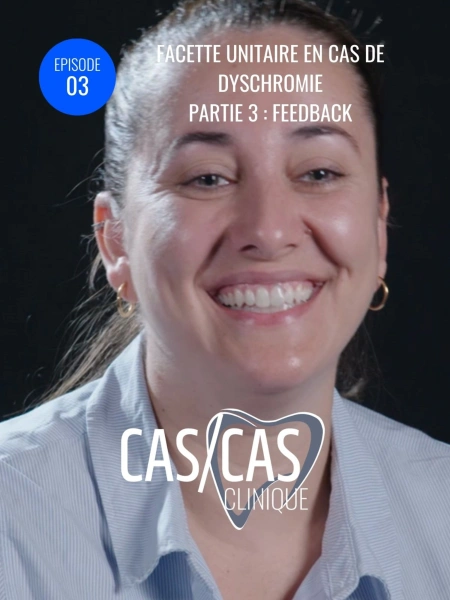 Facette unitaire en cas de dyschromie Partie 3 : Feedback