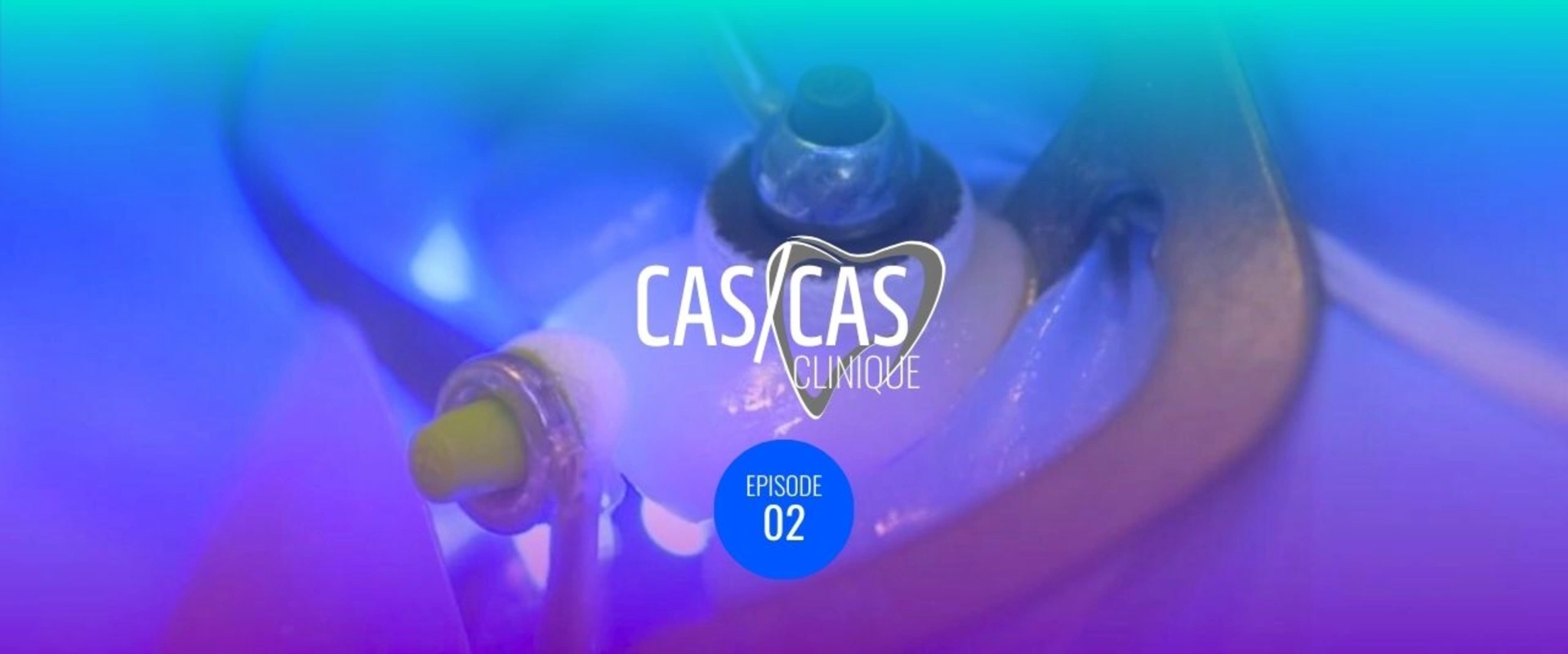 Facette unitaire en cas de dyschromie Partie 2 : Collage